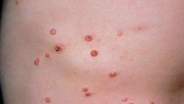 Dieta a frutto di verdure di psoriasi
