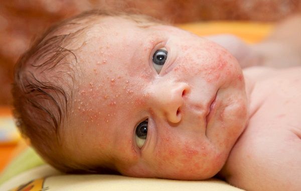 La dieta del bambino di 1 anno a dermatite atopic