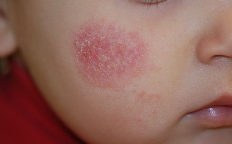 Fango terapeutico da neurodermatitis