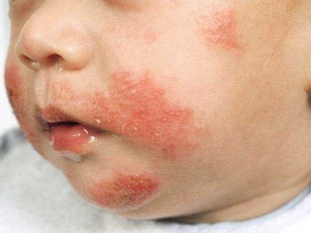 Eczema allatto di eliminazione di bambini di un prurito a eczema