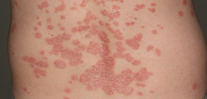 Unguento contro posizione di eczema