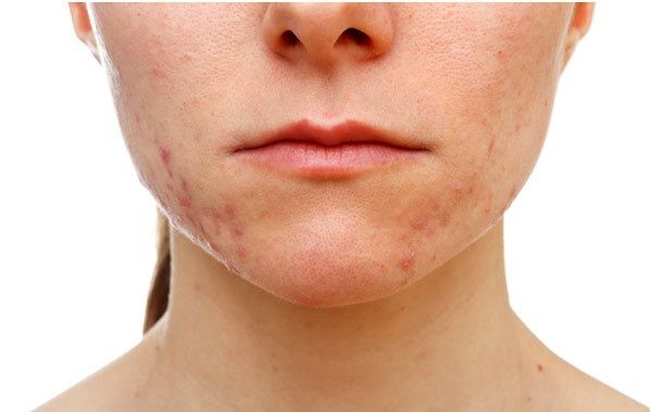 Lacido di salicylic candeggia risposte della pelle
