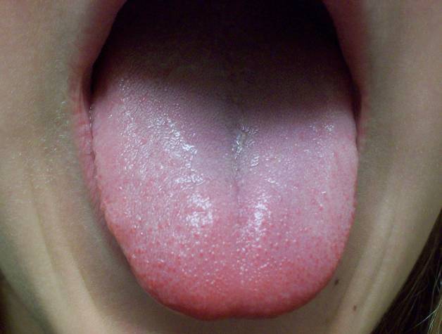Malattia Della Lingua Bianca