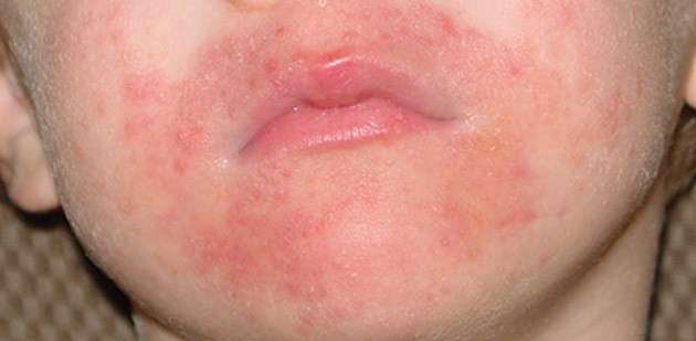 Cura di cicatrici per eczema