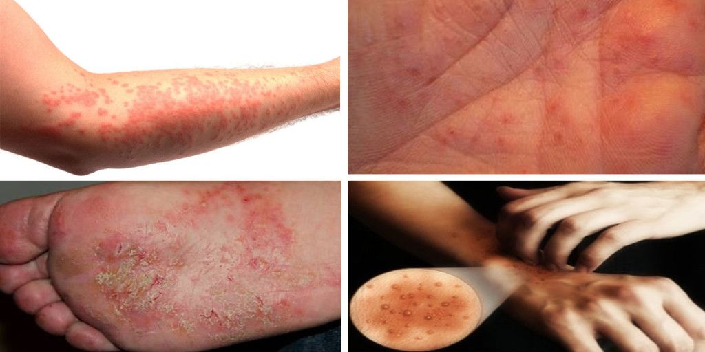 Se la psoriasi il bambino può superare