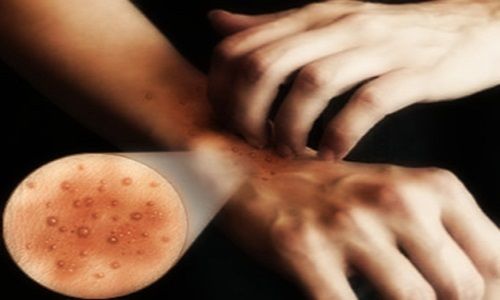 Medicina di psoriasi in una farmacia