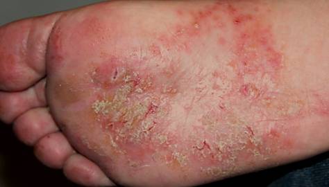 Eczema is a condition - WebMD