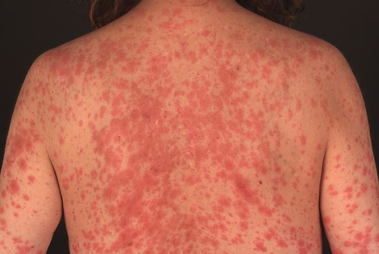 Febbre reumatica cos’è, sintomi, diagnosi e terapia