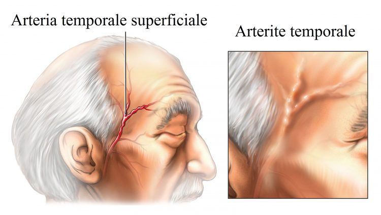 Emorroidi trattamento esterno le migliori medicine