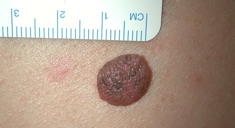 Pigmentazione leggera su pelle
