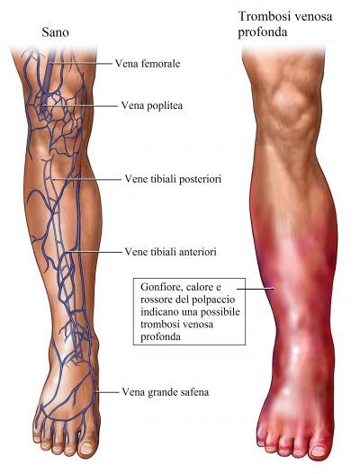 Allatto di bruciato di varicosity di vene può