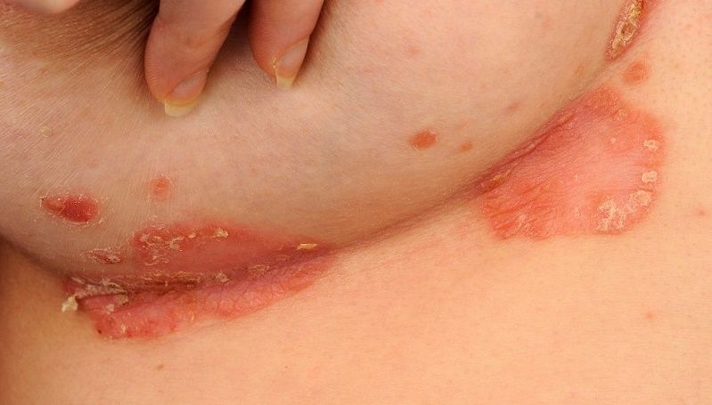 Eczema su mani e gravidanza