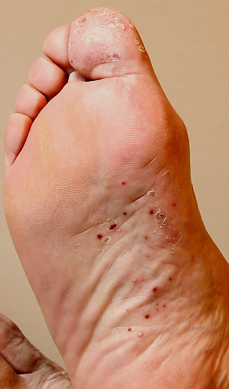 Lo schema di cura di unacne con antibiotici