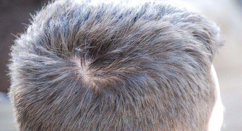 Eczema di una parte di capelli della testa