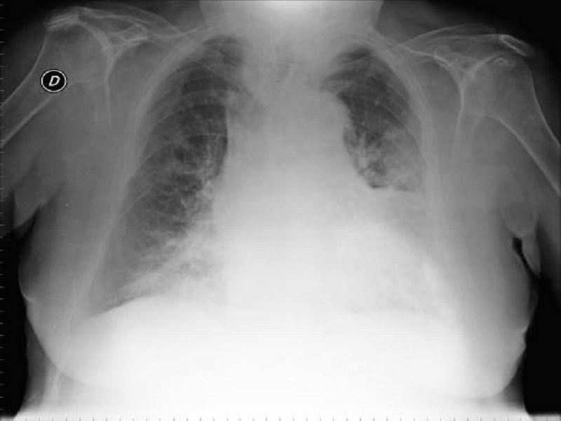 Addensamento Parenchimale A Vetro Smerigliato Significato Addensamento parenchimale: cos'è, cause e cura