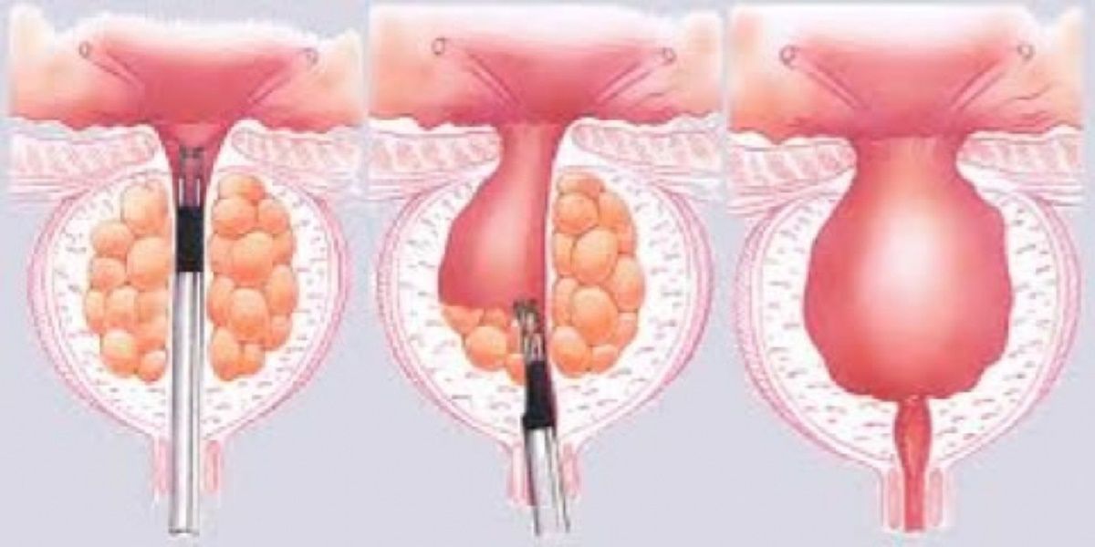 Come scegliere il collant di compressione a varicosity