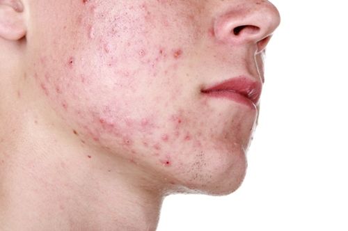 I pacchi di faccia che si schiariscono alle condizioni di casa