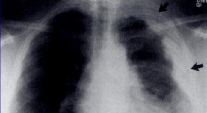 Mesotelioma Peritoneale