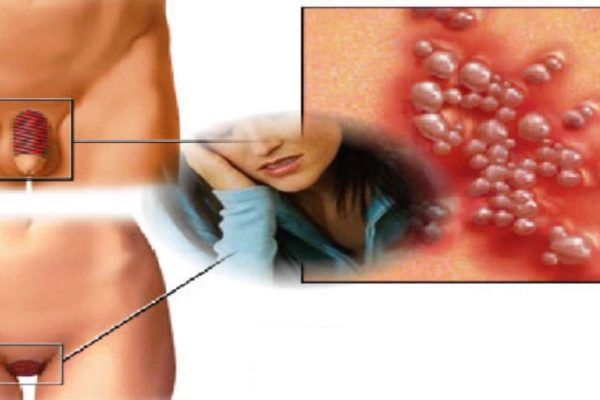 Assistenza di medicina di emorroidi
