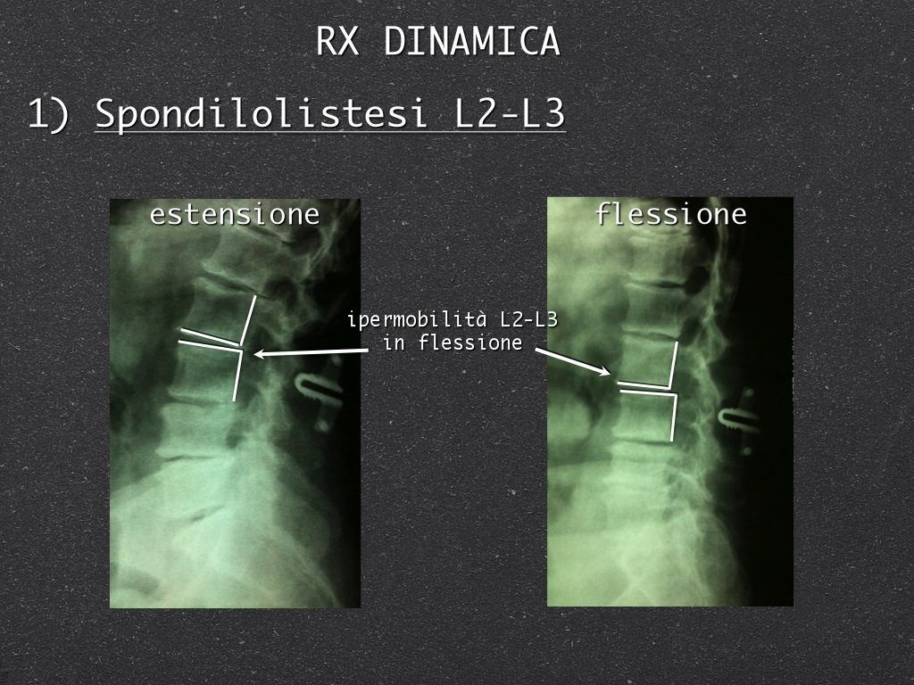 spondilolistesi