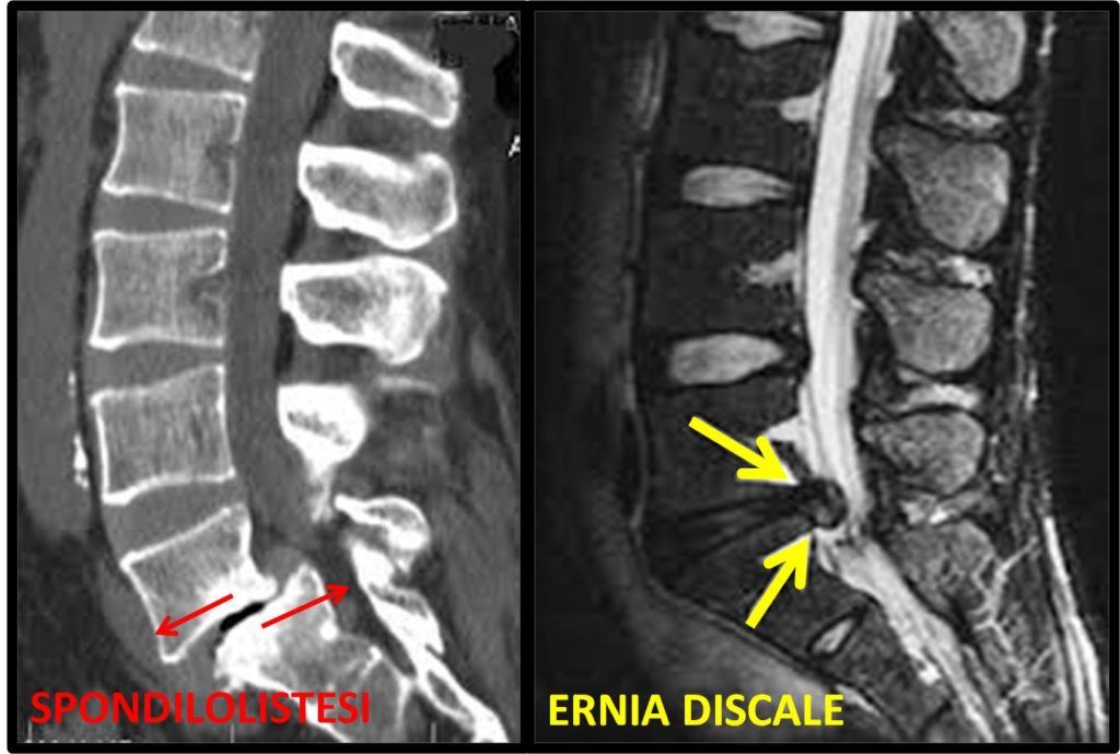 spondilolistesi