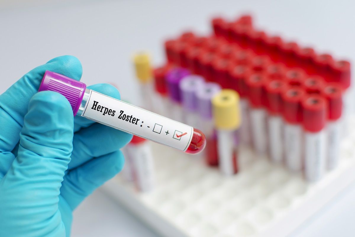 Il test per l'Herpes Zoster