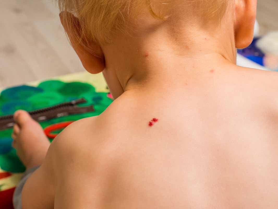 Come curare l’angioma rubino