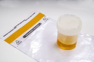 Proteine nelle urine