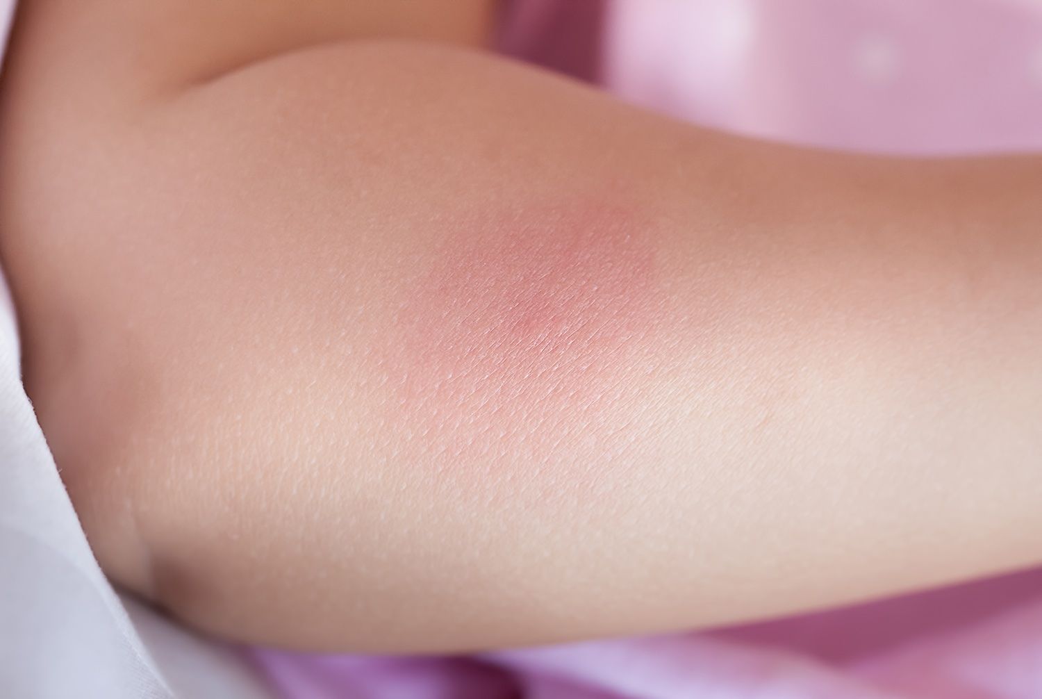 Orticaria