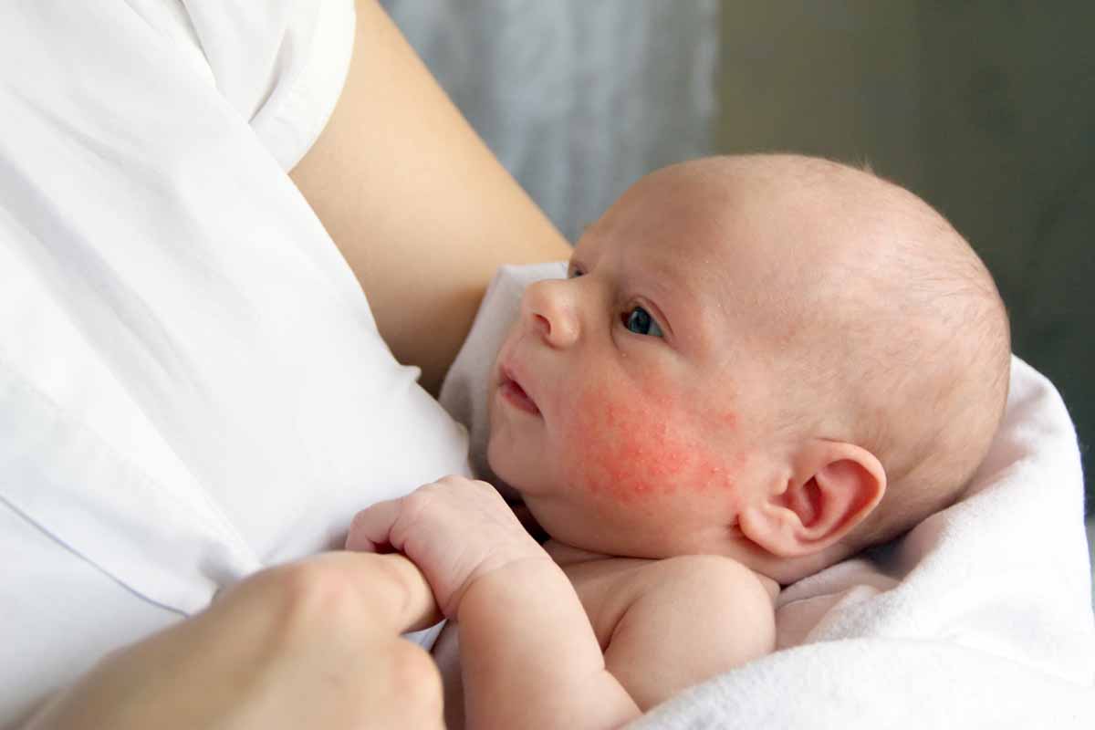 Eczema atopico: Le cause