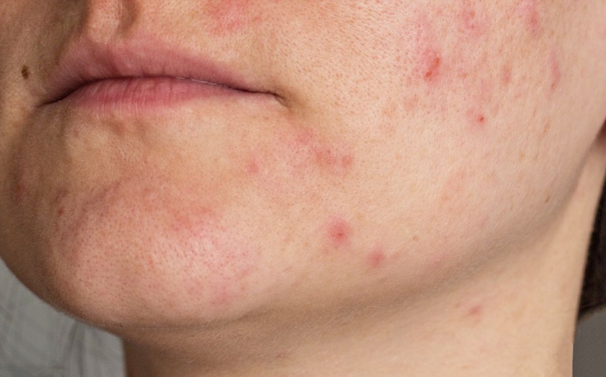 Acne cistica