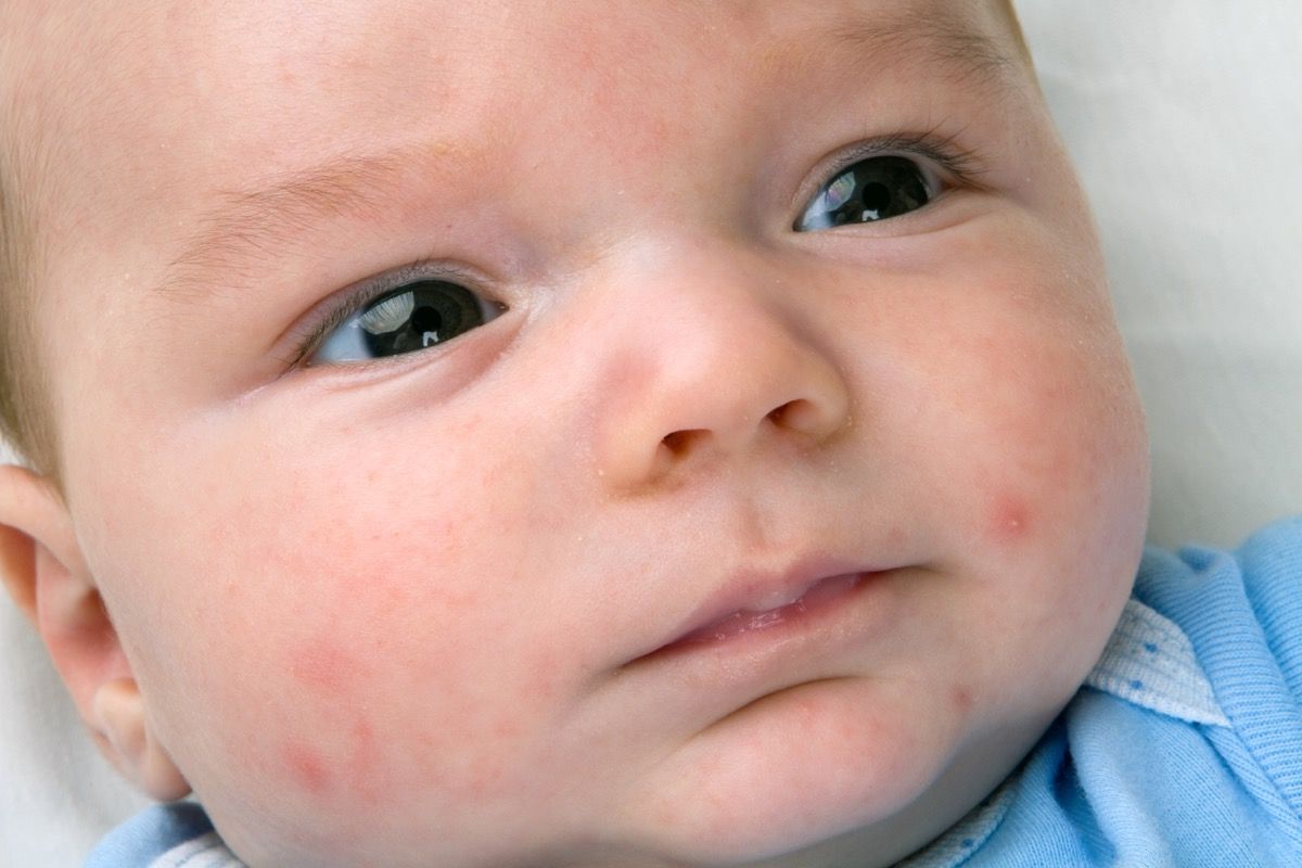 Acne neonatale