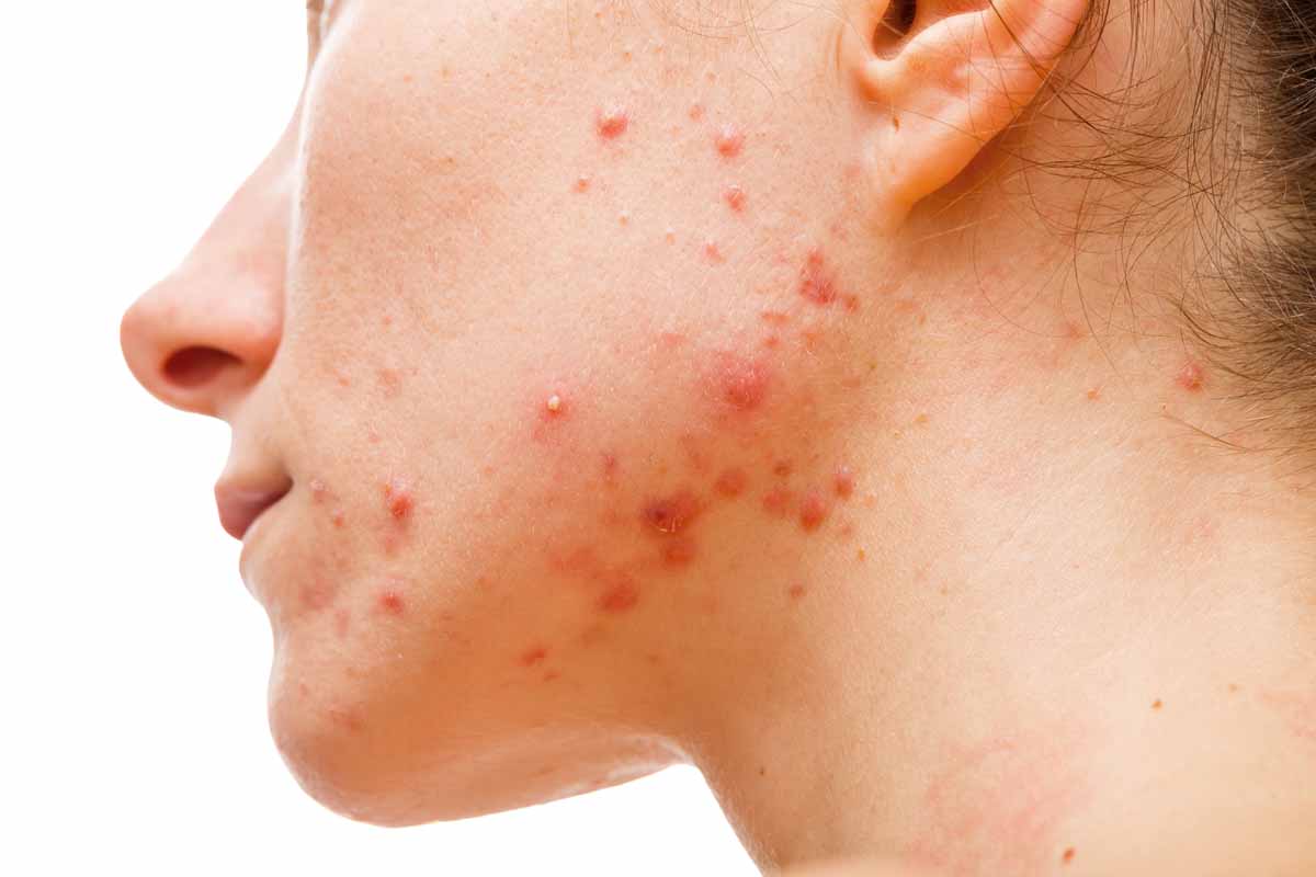 Cosa è e perchè sorge l'acne cistica