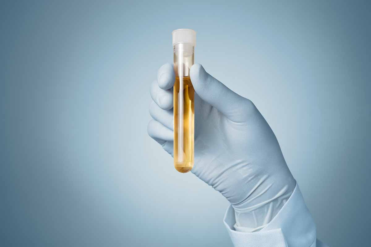 Test di nitriti nelle urine e test dell’esterasi leucocitica