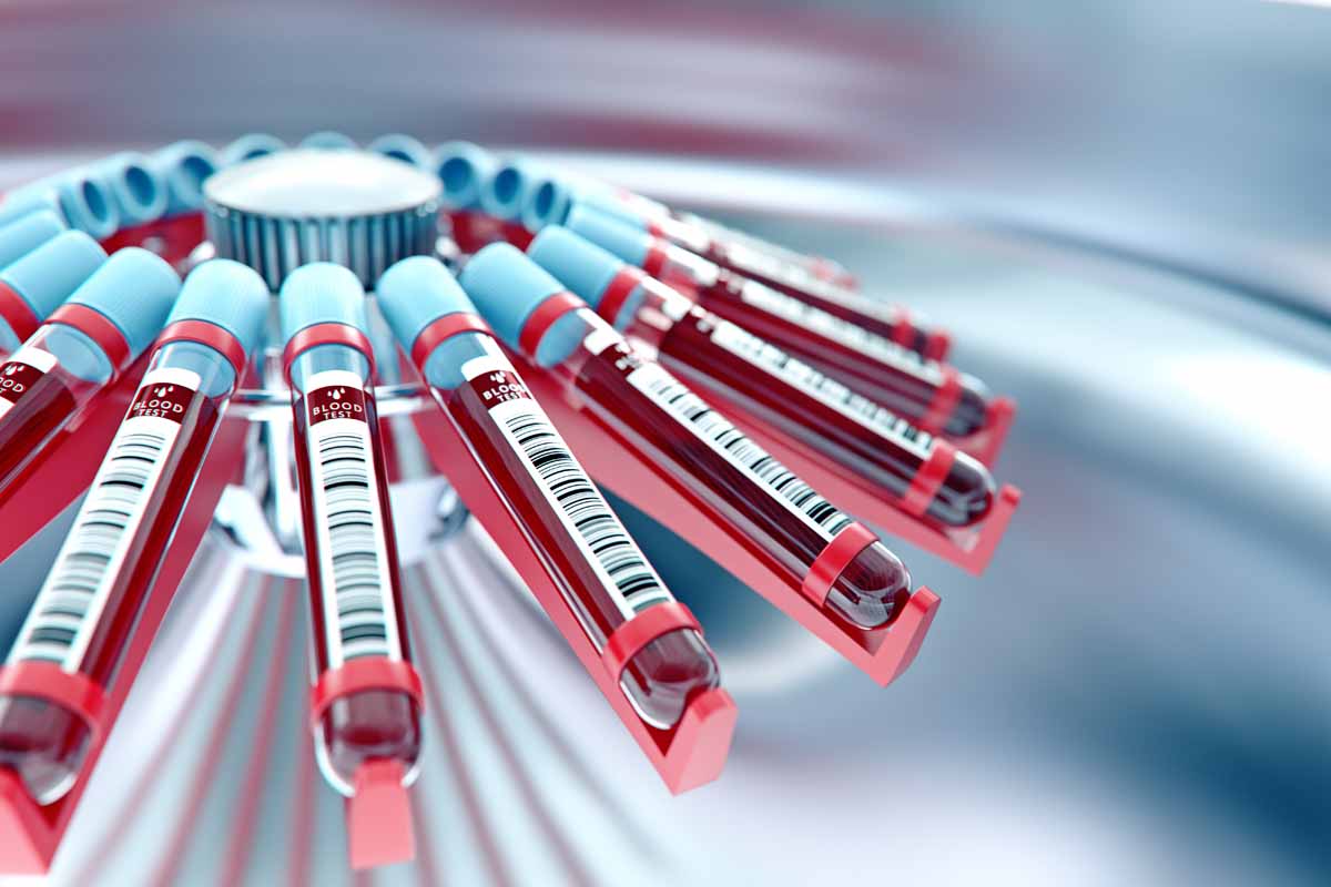 L’ urea alta: quale la dieta? Quali gli alimenti da evitare?
