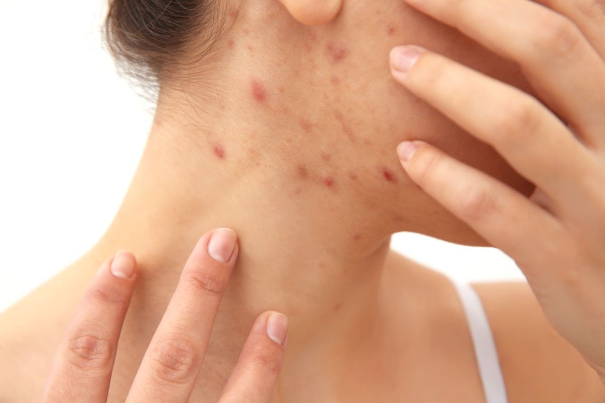 Psoriasi guttata