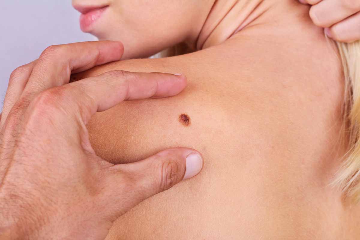 Chi colpisce il melanoma cutaneo