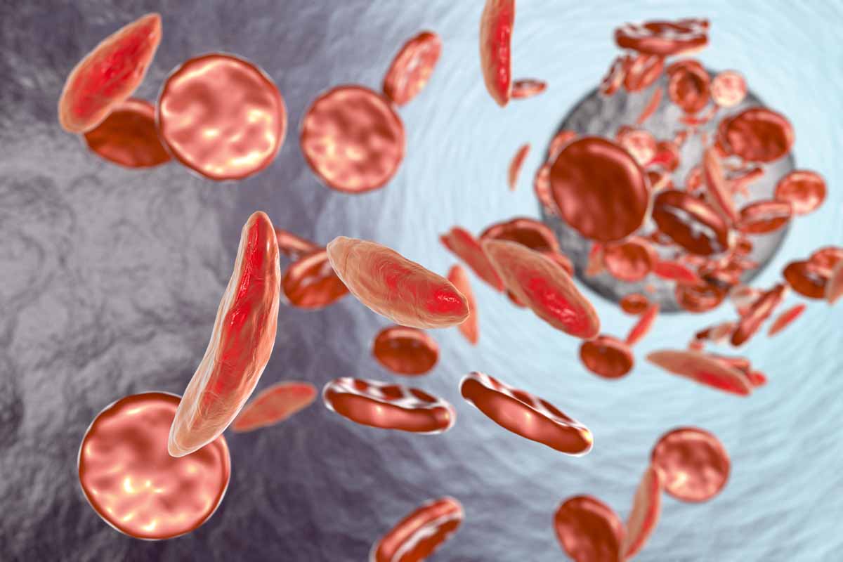 La sintomatologia della anemia aplastica