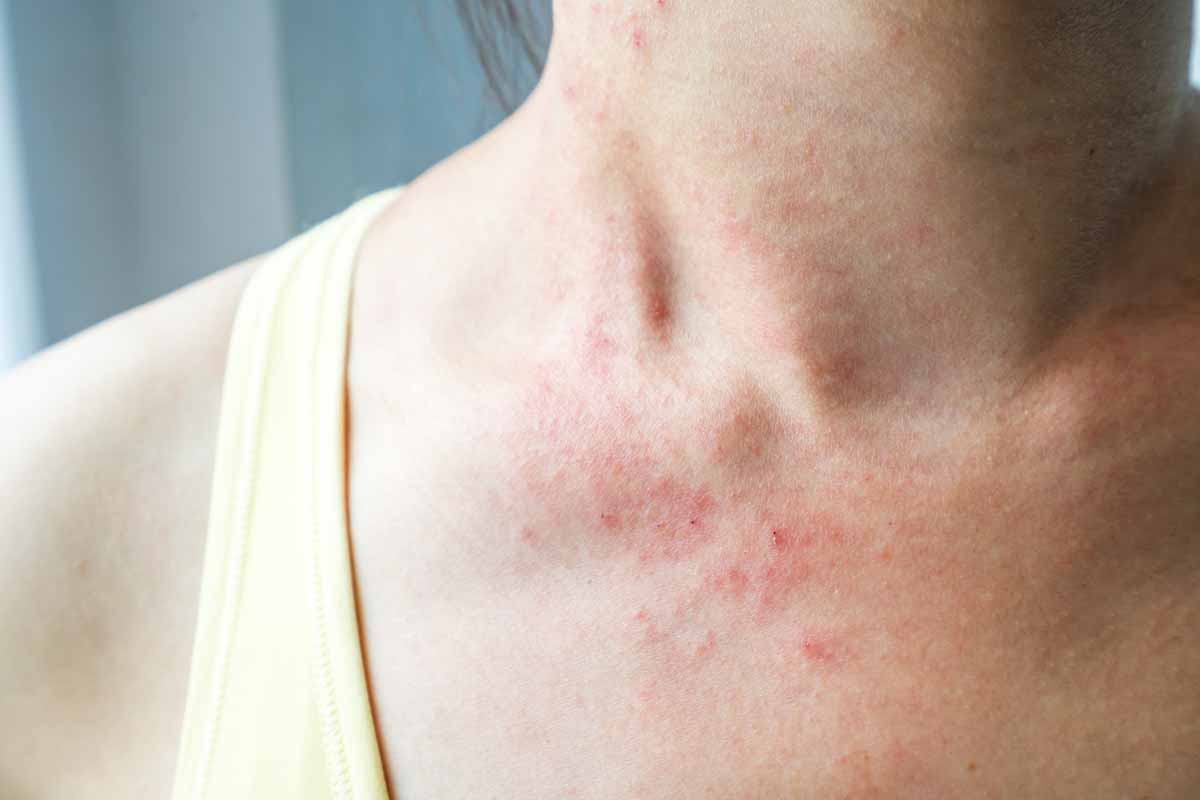 Orticaria colinergica Orticaria colinergica