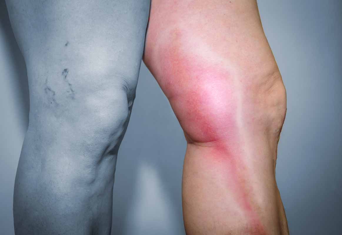 Tromboflebite Tromboflebite