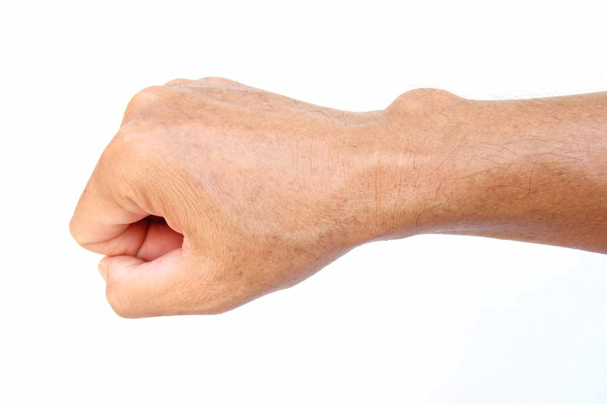 cisti tendinea cisti tendinea