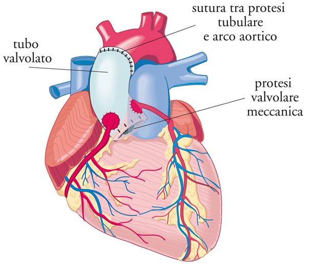 SOSTITUZIONE VALVOLA AORTICA