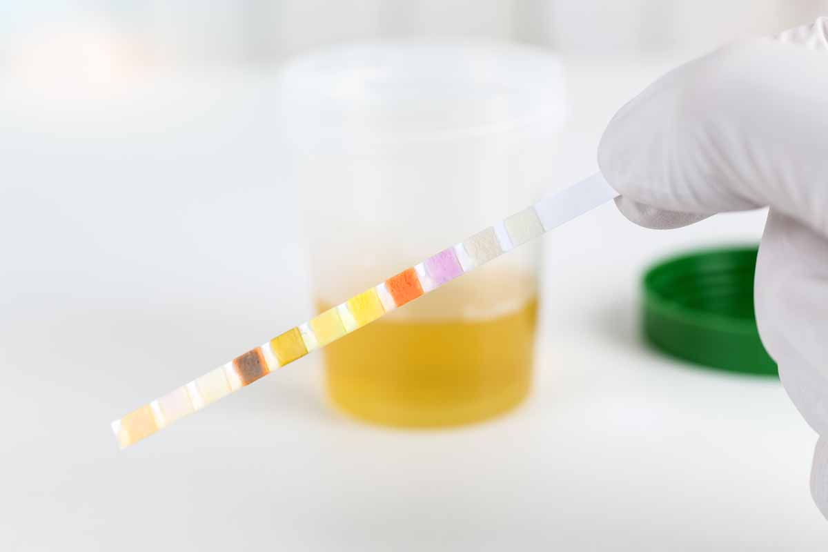 I globuli rossi nelle urine sono conosciuti come ematuria