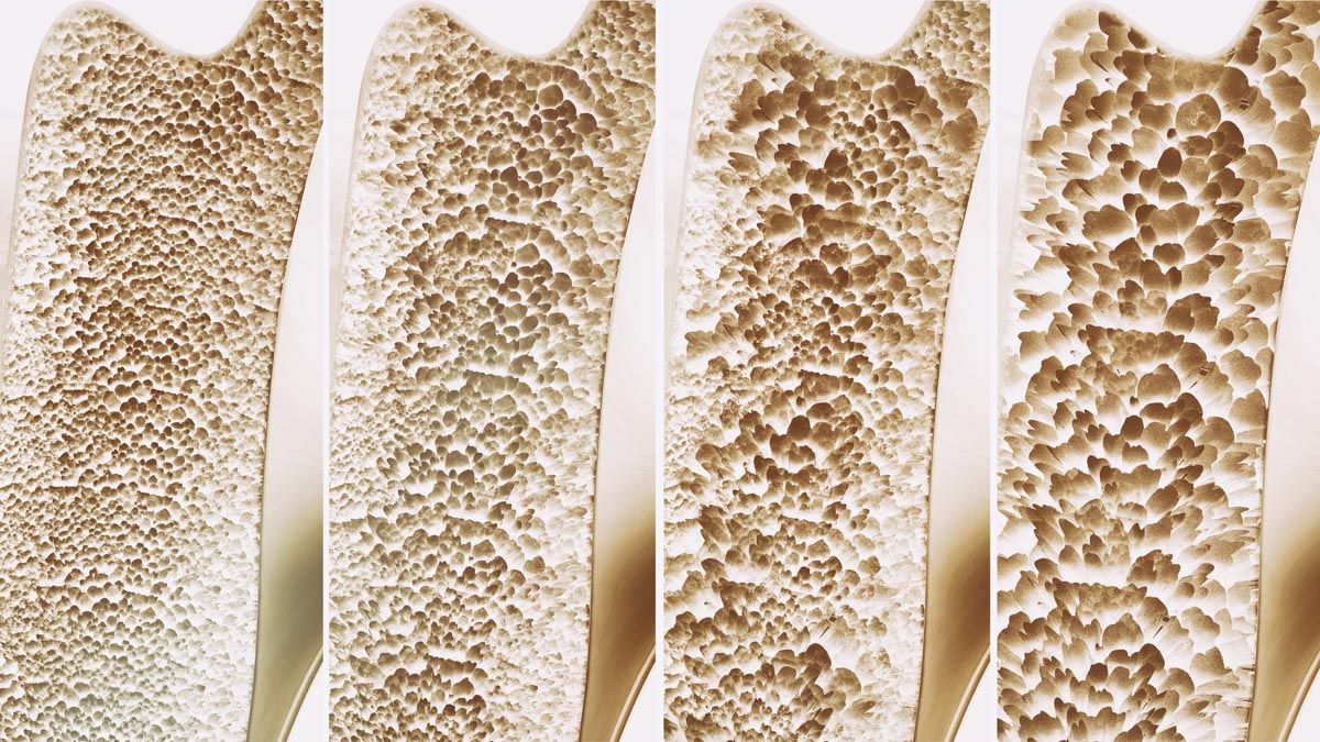 Sintomi degli osteofiti e dell'osteofitosi