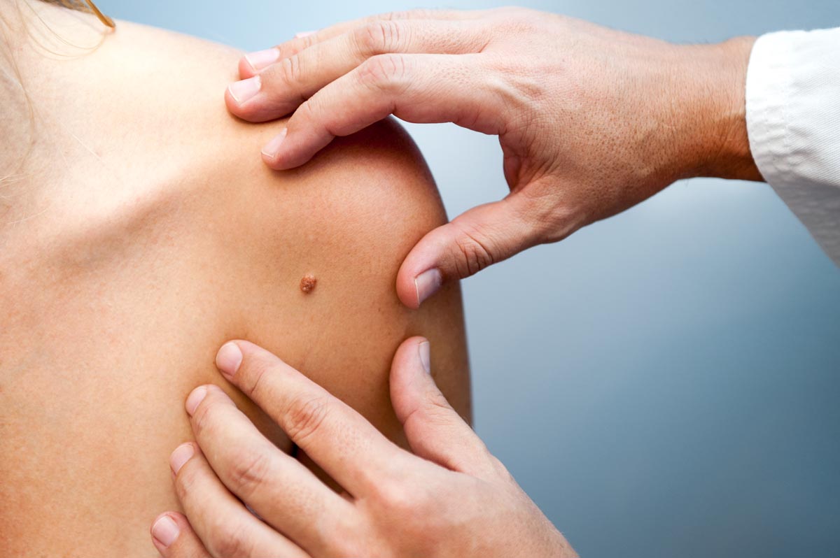 Melanoma nodulare: incidenza ed origini