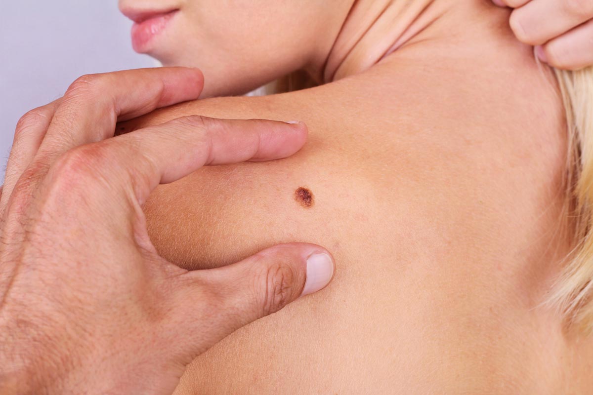 Melanoma nodulare: diagnosi