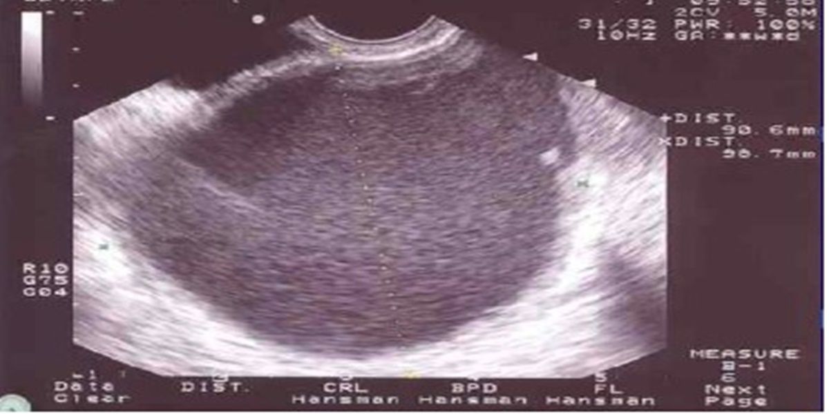 Cisti endometriosica Cisti endometriosica
