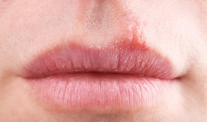 Herpes simplex Herpes simplex
