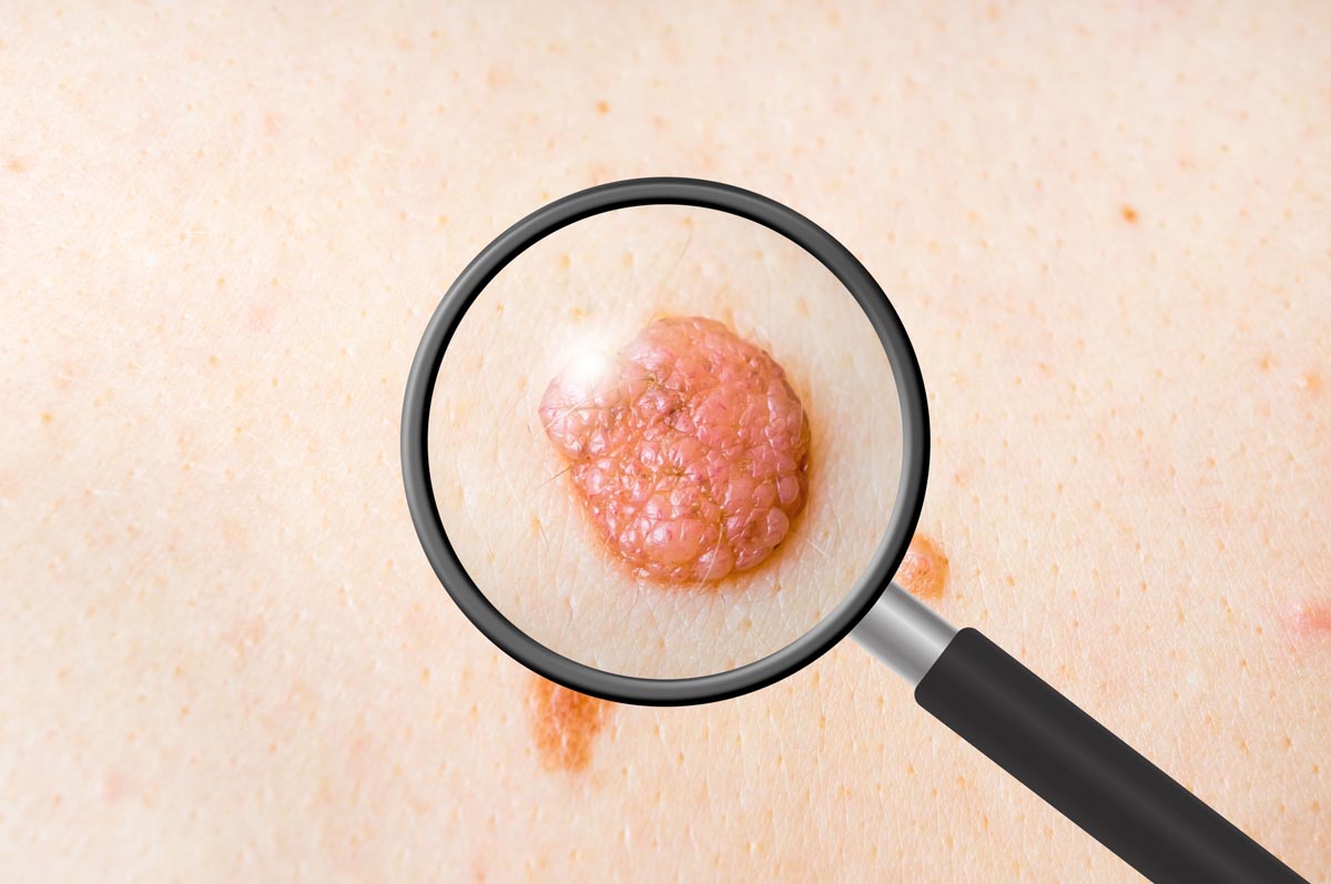 Carcinoma basocellulare terapie