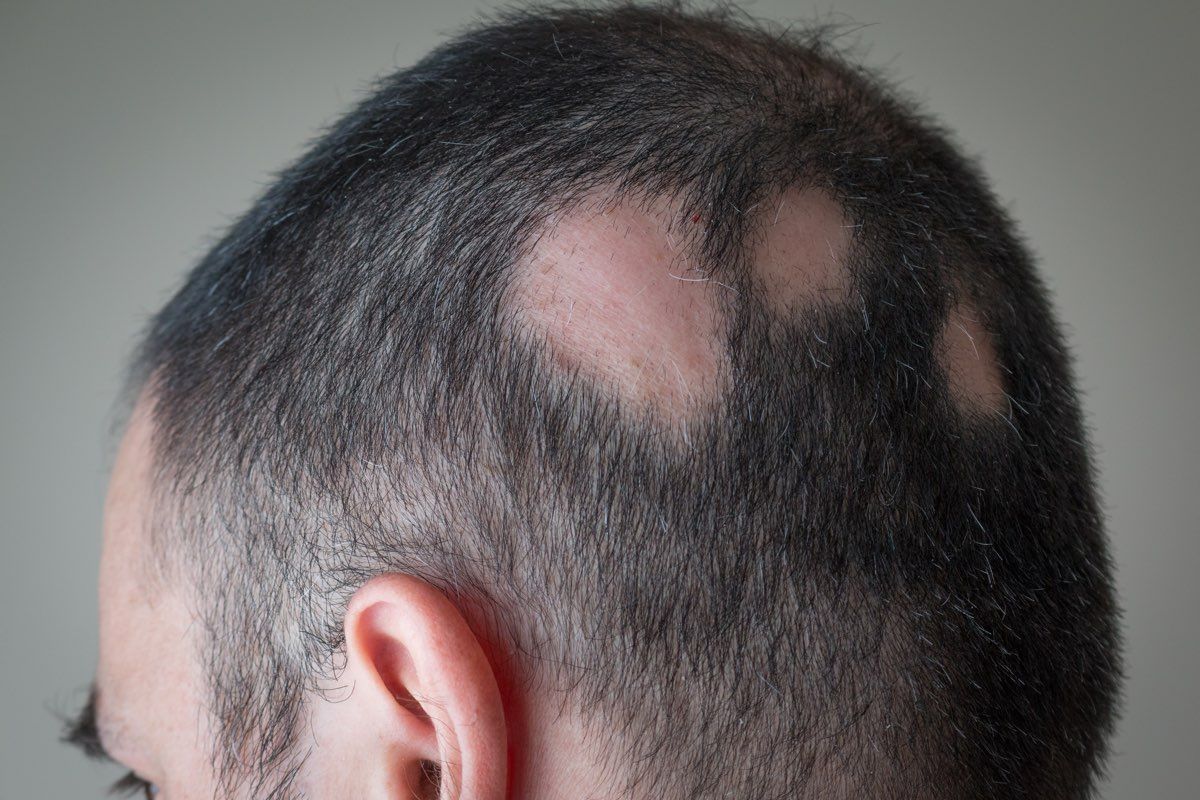 Alopecia